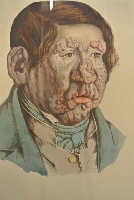 Leper